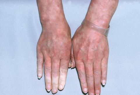 hand arm vibration syndrome